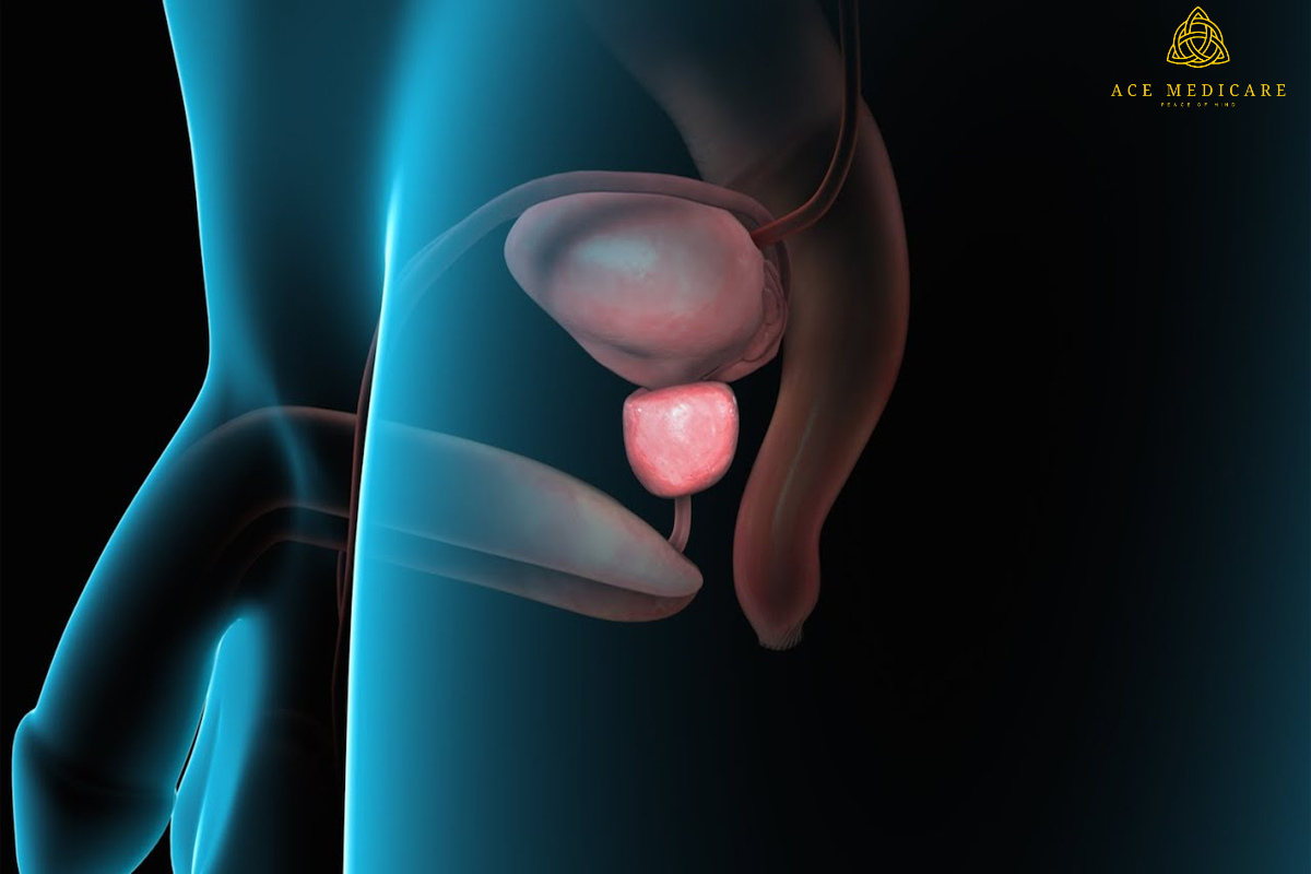 Natural Remedies for Managing Enlarged Prostate Symptoms